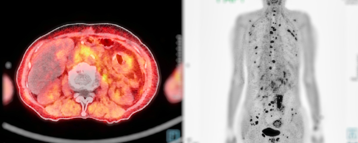 The PSMA PET/CT scan improves detection of metastatic or recurrent prostate cancer