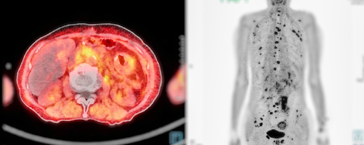 PSMA PET For Recurrent Prostate Cancer Is A Game Changer