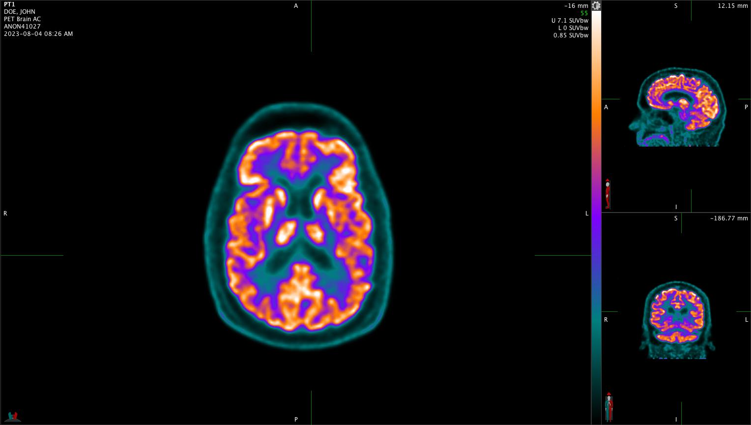 Positron Emission Tomography Brain Scan